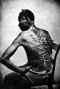 Photograph of the scars of a slave, flogged on the back, 2 April 1863, Baton Rouge, Louisiana, USA